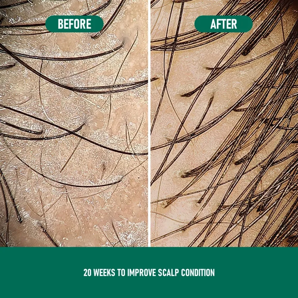 CH004 Minoxidil 5% anti-hair loss mousse foam canister for hair regrowth treatment