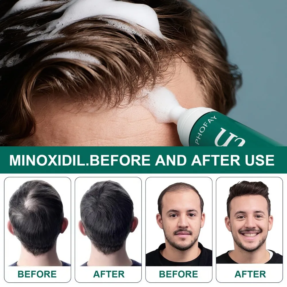 CH004 Minoxidil 5% anti-hair loss mousse foam canister for hair regrowth treatment