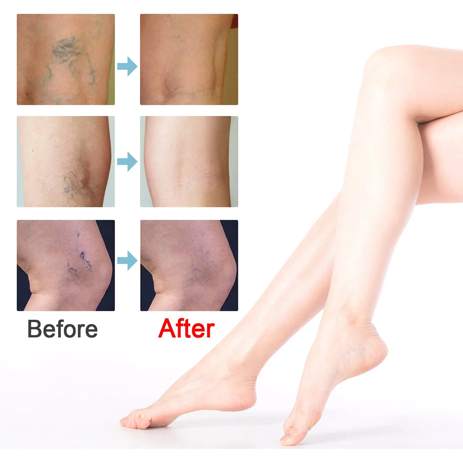 20g vein repair cream container for leg vein relief and green tendon bulge appearance