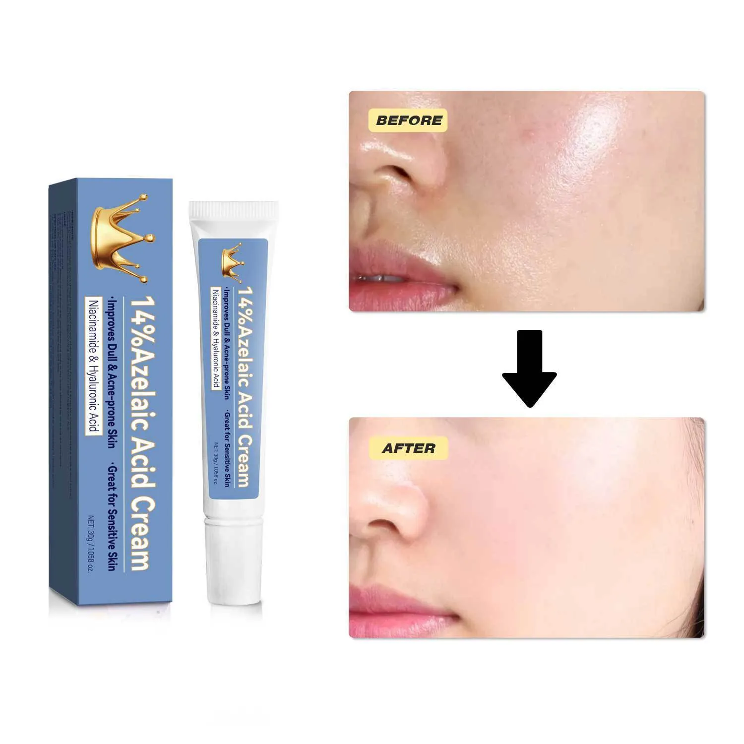 Blue tube of 30g azelaic acid cream with FP-A035 specification code