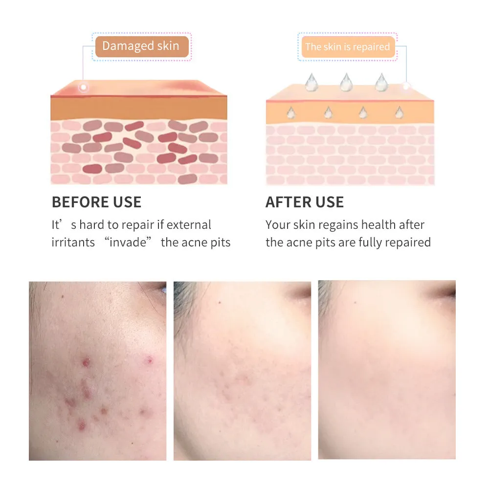 Green acne scar removal gel in a compact tube with tea tree extract for blemish treatment