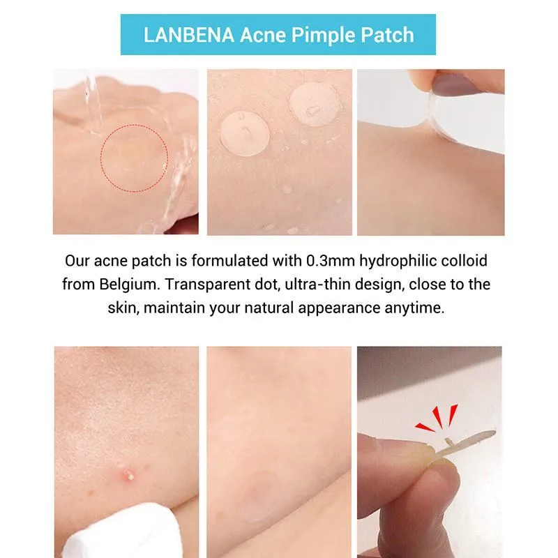 Acne stickers with tea tree oil and Calendula oil for treating blemishes and fading acne marks on scar-prone skin