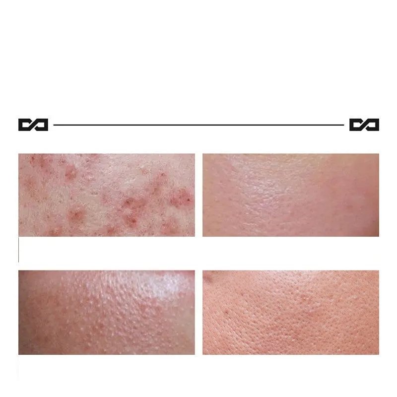 Herbal Lightening Acne Cream 100g tube with niacinamide and salicylic acid for acne-prone skin