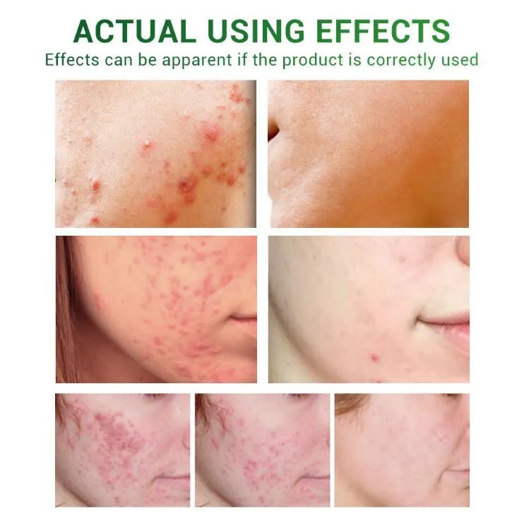 Acne treatment serum facial repair oil with Camellia sinensis leaf extract liquid formulation