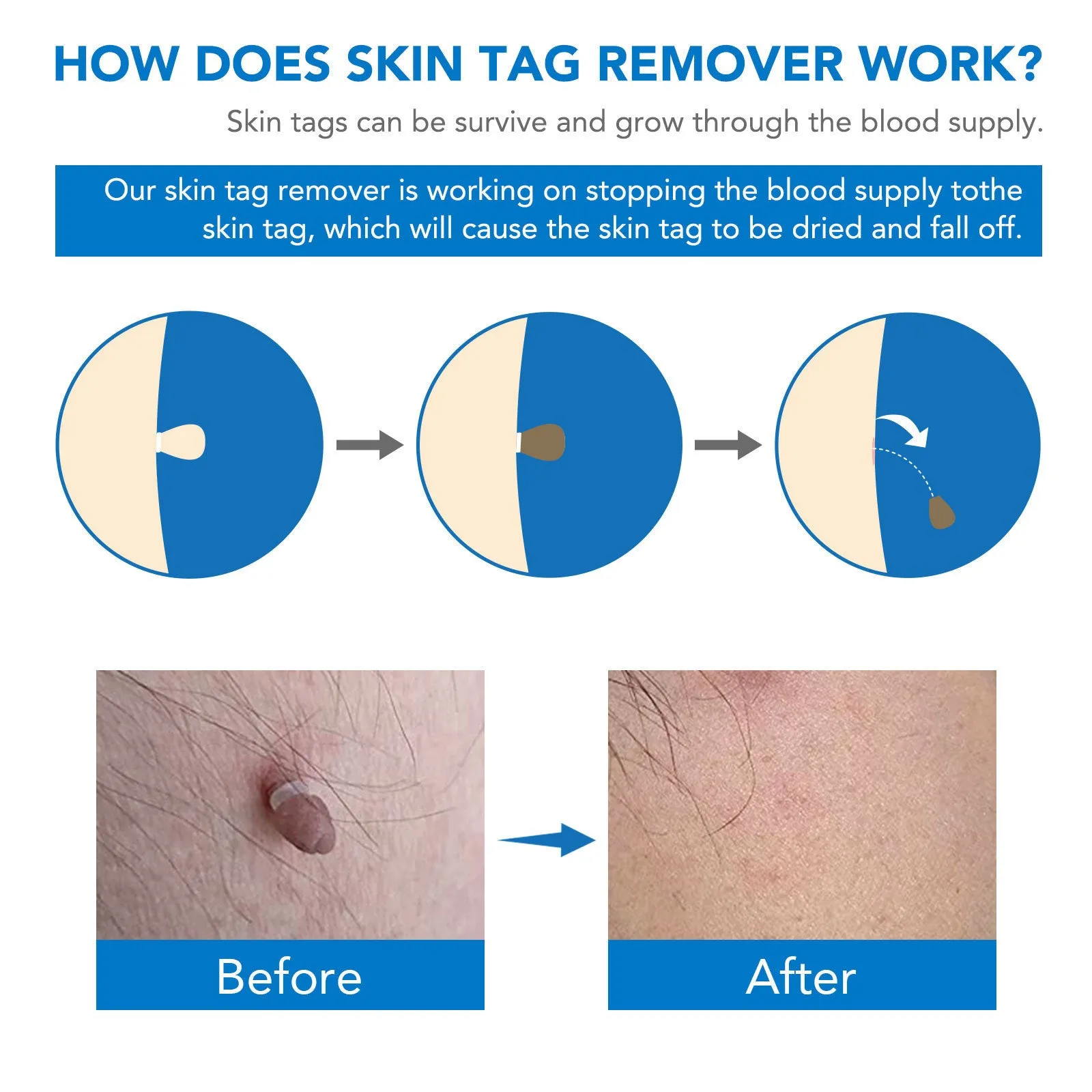 SEFUDUN Simple Wart Removal Tool in blue, green, and orange for at-home mole and skin tag removal
