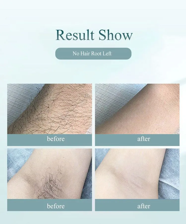 Compact laser hair removal handset in dark green with 8 power levels and skin rejuvenation