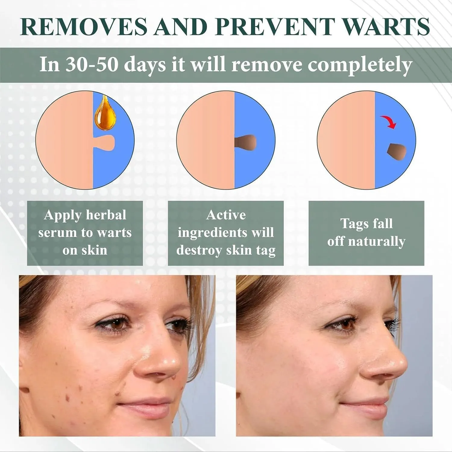 Natureerase Instant Mole Spot Removal Gel 45g pump bottle hydrating spot treatment