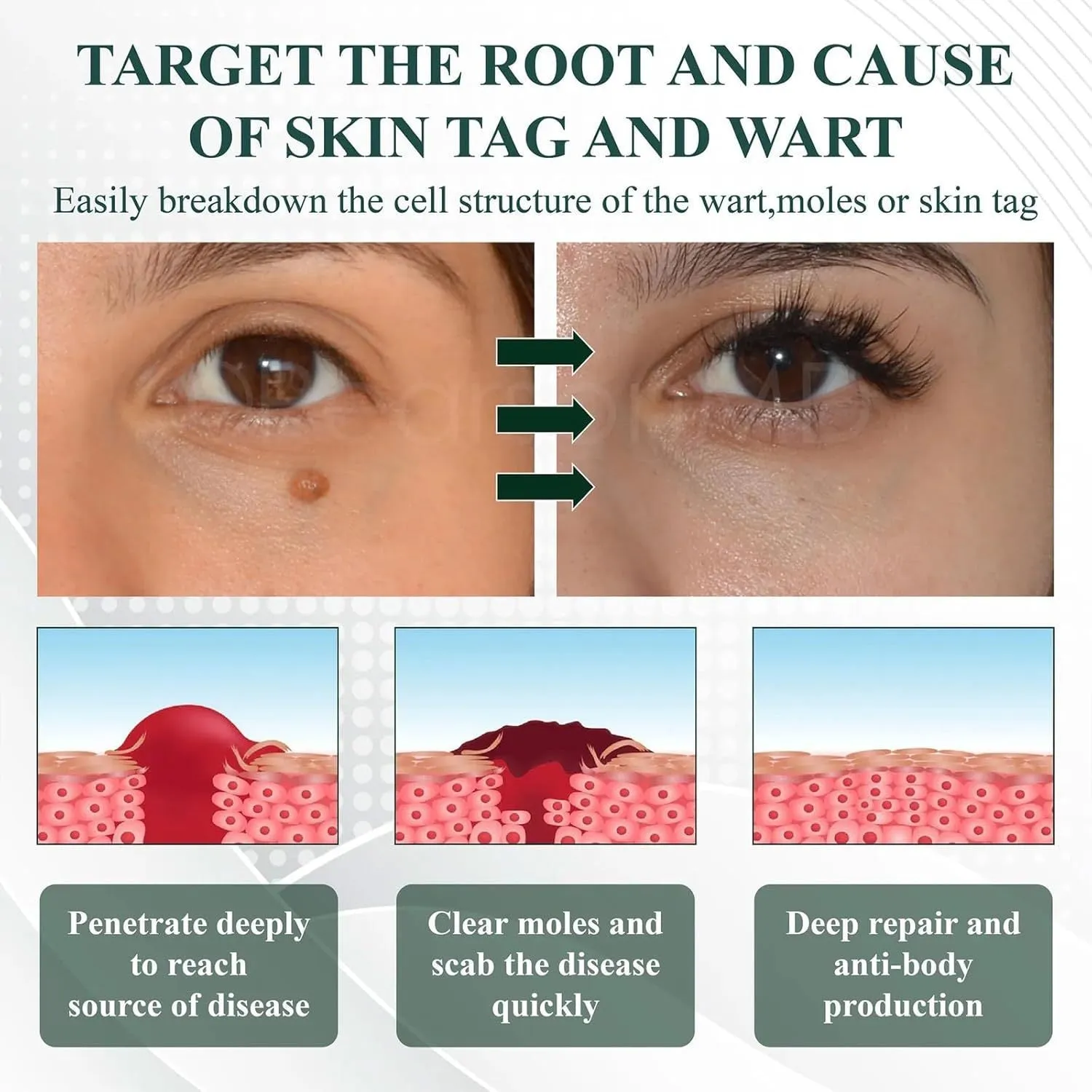 Natureerase Instant Mole Spot Removal Gel 45g pump bottle hydrating spot treatment