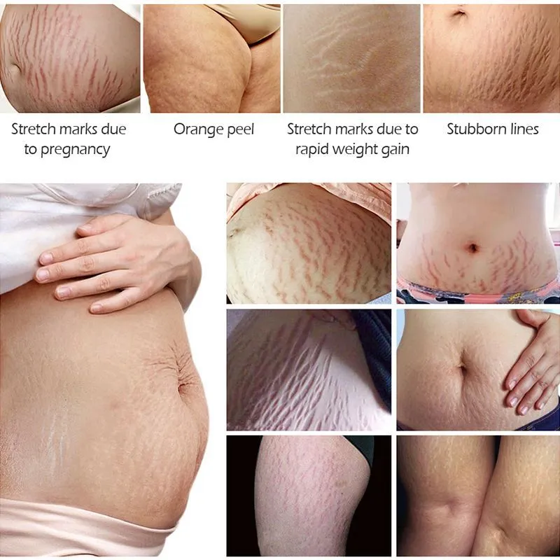 Tea tree stretch mark remover essential oil in 20ml box with colour packaging
