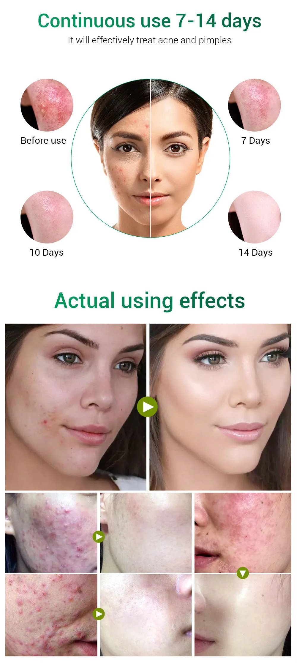 BREYLEE Tea Tree Acne Cream pot with moisturising acne scar treatment for general skin