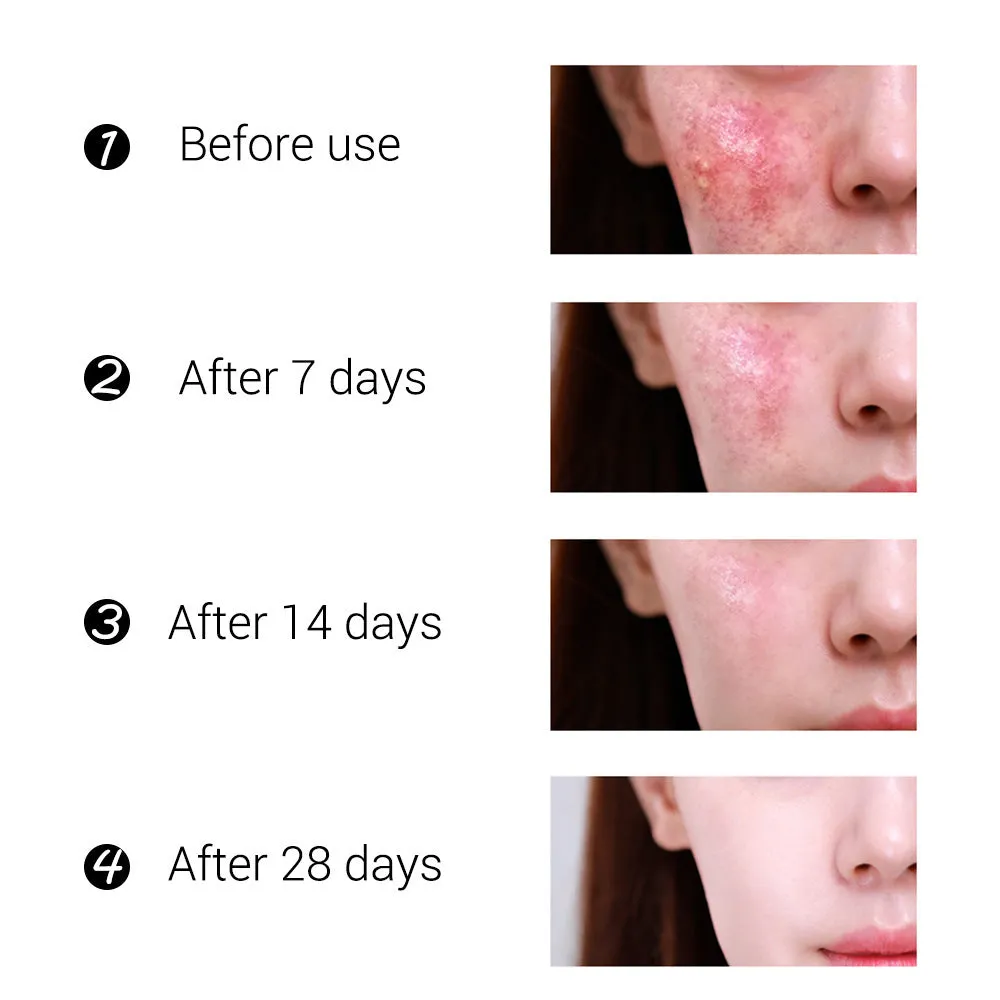 BREYLEE Tea Tree Acne Cream pot with moisturising acne scar treatment for general skin