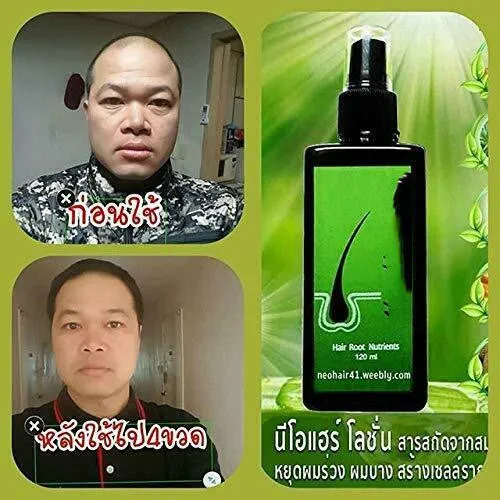Anti-hair loss shampoo 120ml bottle with dandruff removal, anti-itch, deep repair, nourishing, and scalp oil control, plus free microneedling roller gift