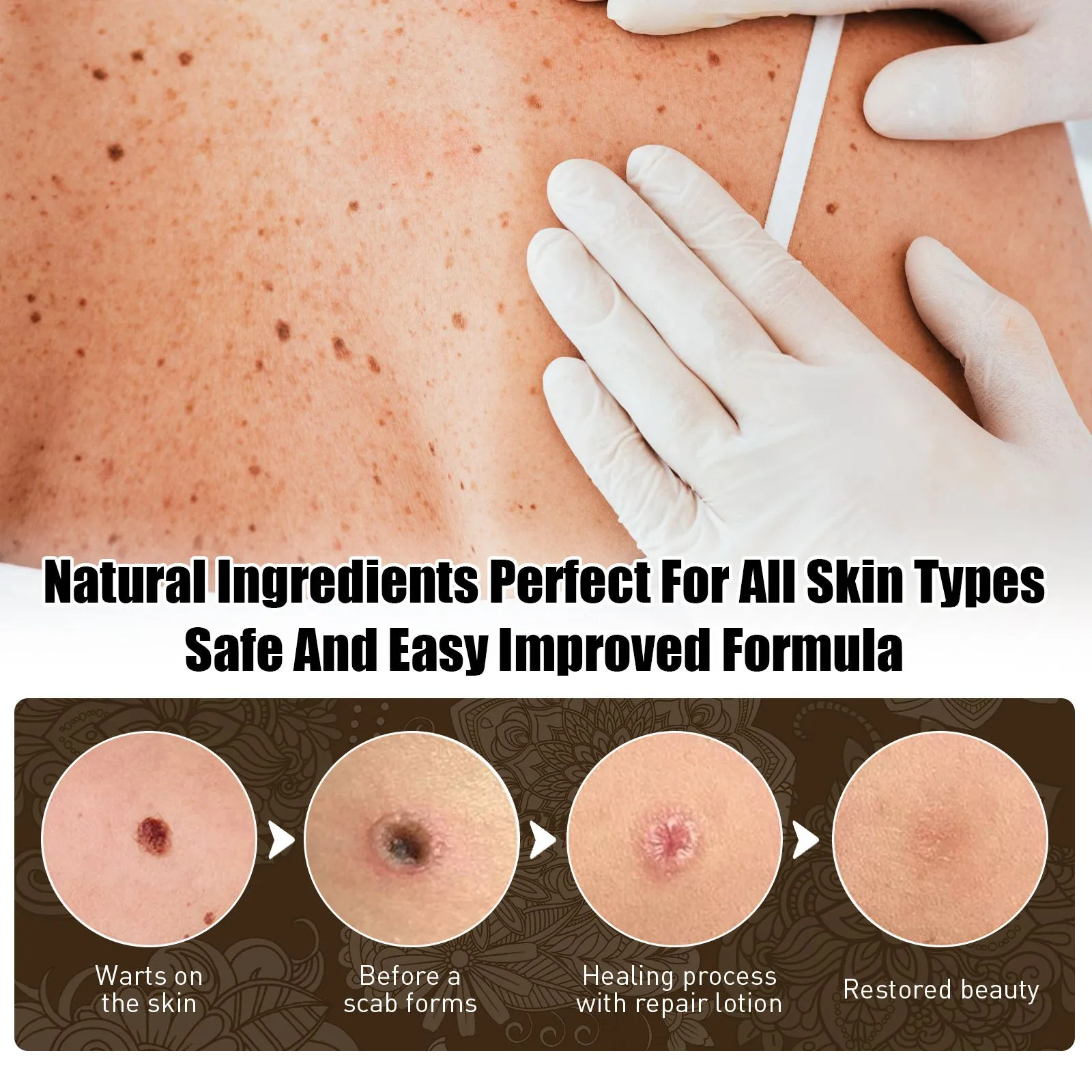 Skin Cleansing Black Mole Wart Skin care lotion 25ml for hand foot face armpit neck care