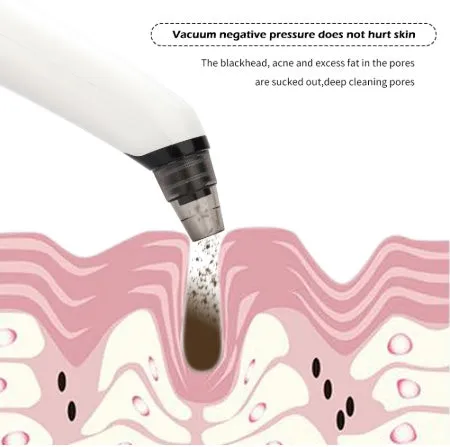 Blackhead suction instrument with three interchangeable heads for facial pore cleaning and exfoliation