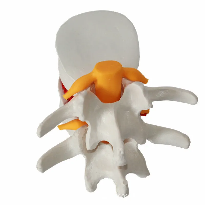 White PVC lumbar intervertebral disc herniation demonstration model showing anatomical details