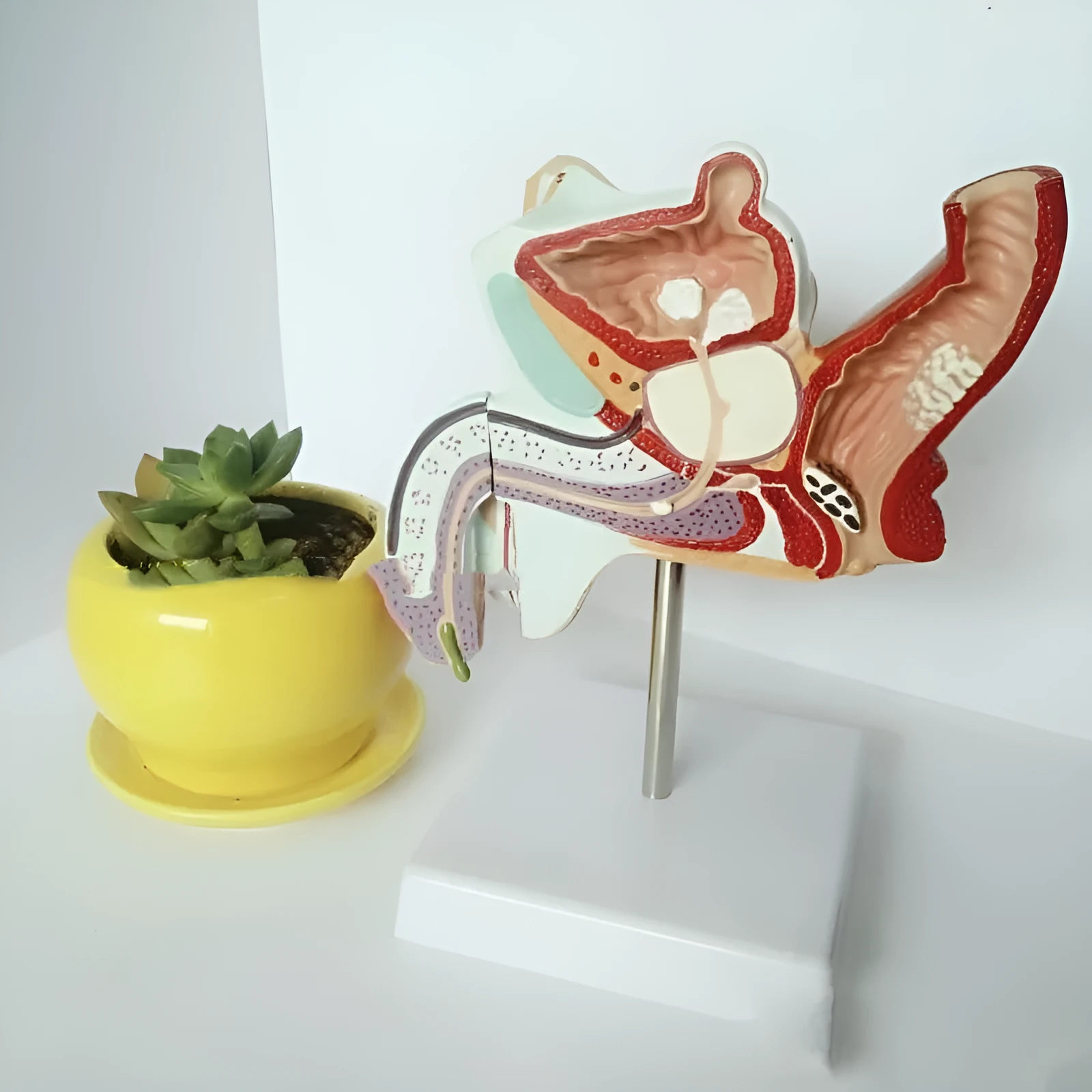 Anatomical male reproductive system pathology model showing detailed disease structures